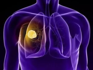 克唑替尼+色瑞替尼序贯治疗NSCLC